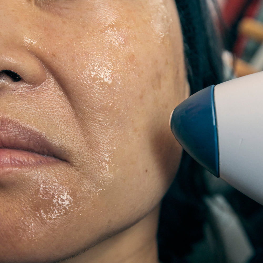 Radio Frequency Skin Tightening Device on Cheek Image