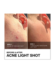 Before and after image with Acne Light Shot Device in 4 weeks